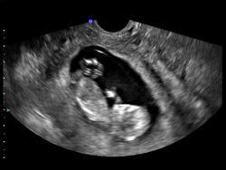 scan after 10 weeks